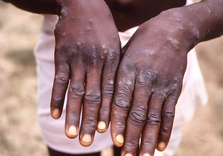 With Mpox a public health emergency in Africa, what you must know about increased virus risk