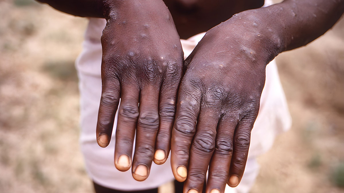 The backs of the hands of a patient with monkeypox showing a rash